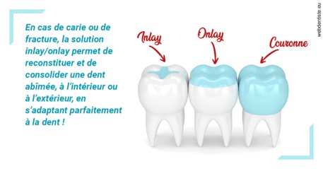 https://selarl-orthodontie-docteur-cuinet.chirurgiens-dentistes.fr/L'INLAY ou l'ONLAY