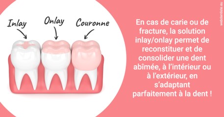 https://selarl-orthodontie-docteur-cuinet.chirurgiens-dentistes.fr/L'INLAY ou l'ONLAY 2