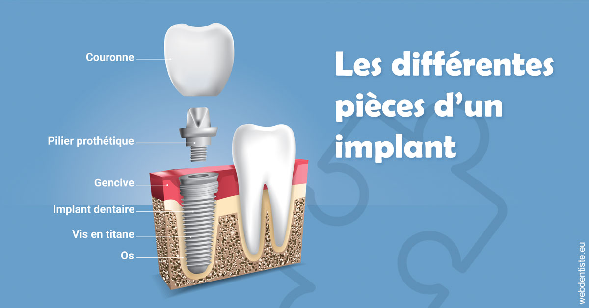 https://selarl-orthodontie-docteur-cuinet.chirurgiens-dentistes.fr/Les différentes pièces d’un implant 1